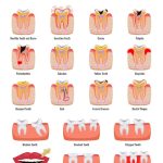 Uncovering the Top Five Reasons Behind Your Pre-Implant Anxiety: Mastering the Fear of Dental Implants