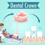 Unraveling the Mystery: Getting Braces and a Root Canal Simultaneously – What You Need to Know.